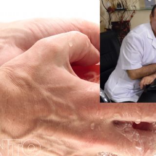 El Doctor Furman habla de la afección más común en nuestras manos: qué es el síndrome del túnel carpiano