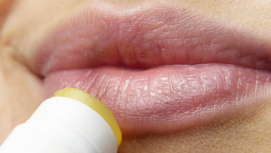 Todo lo que debes saber sobre el herpes labial